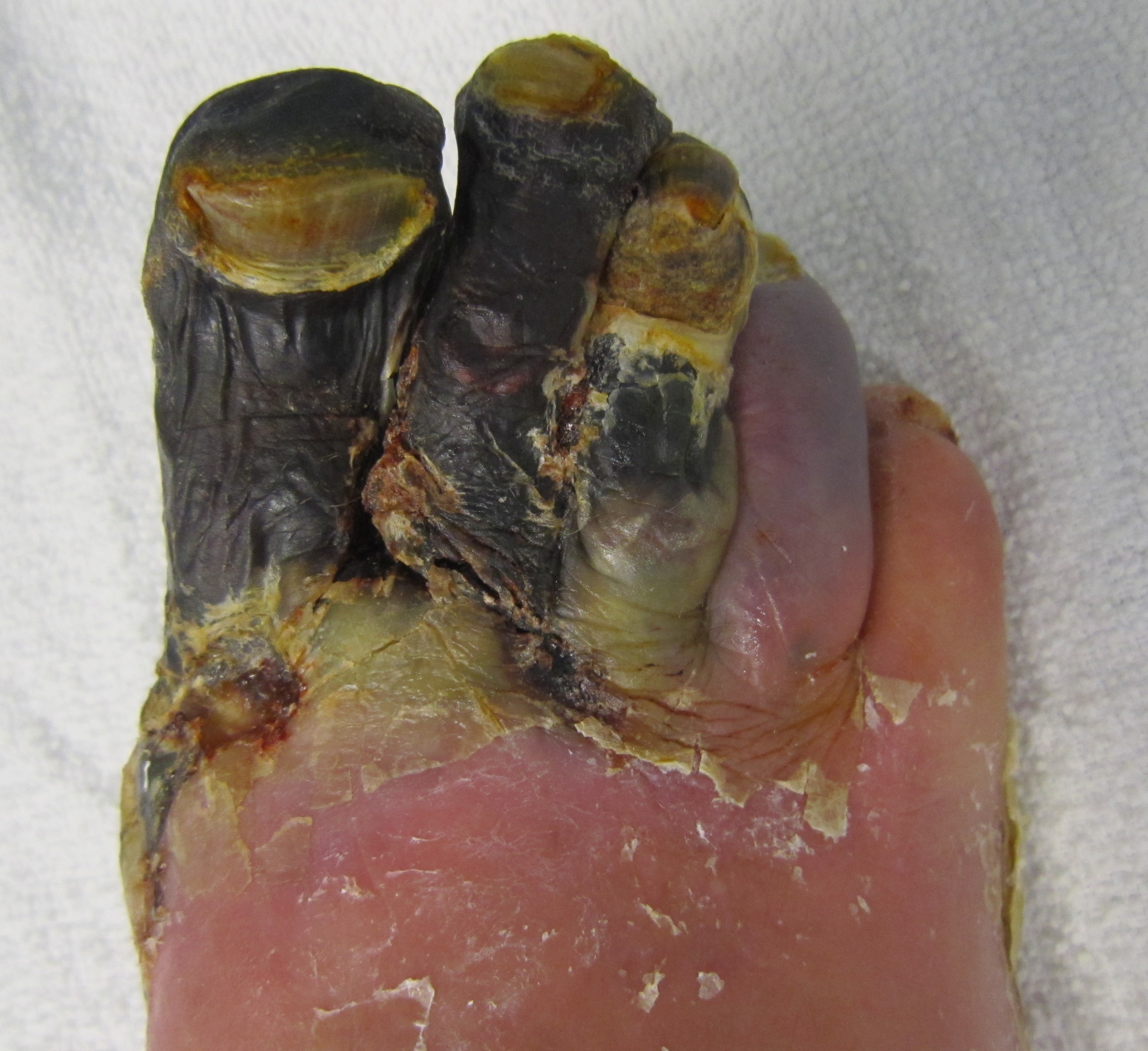 GangreneFoot